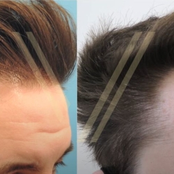 The Complete Guide to Successful Hair Transplants